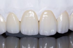 Làm răng sứ có cần lấy tủy răng trước hay không?