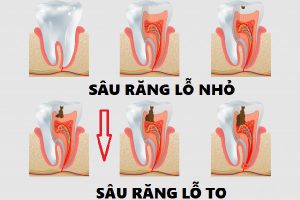 Nguyên nhân gây sâu răng và cách trám răng sâu lỗ nhỏ