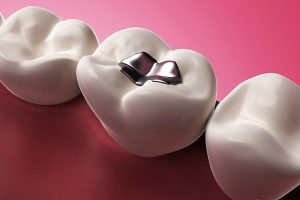 Xin hỏi trám răng sâu có ảnh hưởng gì không?