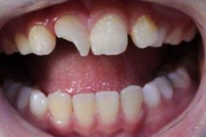 Nguyên nhân răng bị mẻ là gì? Răng mẻ có niềng được không? 