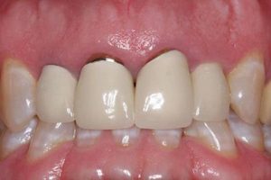 Làm răng sứ bị viêm lợi phải làm sao? Cách khắc phục an toàn cho bạn