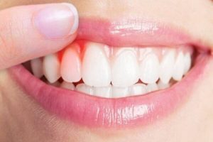 Nguyên nhân và cách điều trị bọc răng sứ đánh răng bị chảy máu