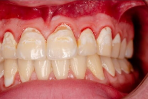 Lý do tại sao trẻ bị viêm nướu răng?