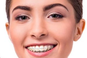 Chế độ chăm sóc trong và sau khi niềng răng mắc cài sứ
