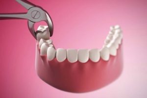 Nhổ răng khôn xong có lỗ có ảnh hưởng tới sức khỏe?