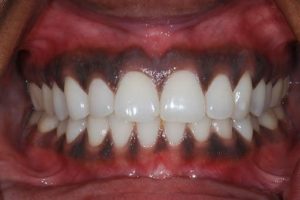 Nướu răng bị thâm đen thì phải làm sao? Cách điều trị an toàn